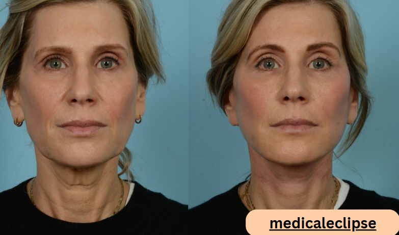 How a Mini Face Lift Can Provide a More Youthful Appearance
