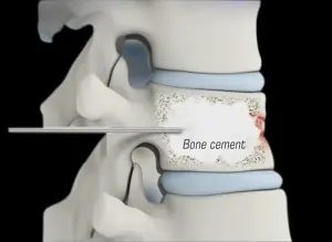 Kyphoplasty as a Treatment for Osteoporotic Fractures
