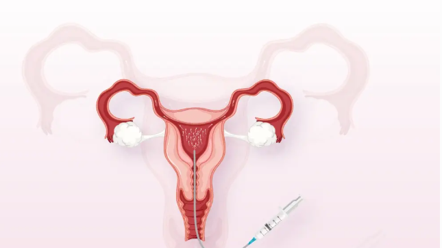 The Role of IVF and Male Infertility